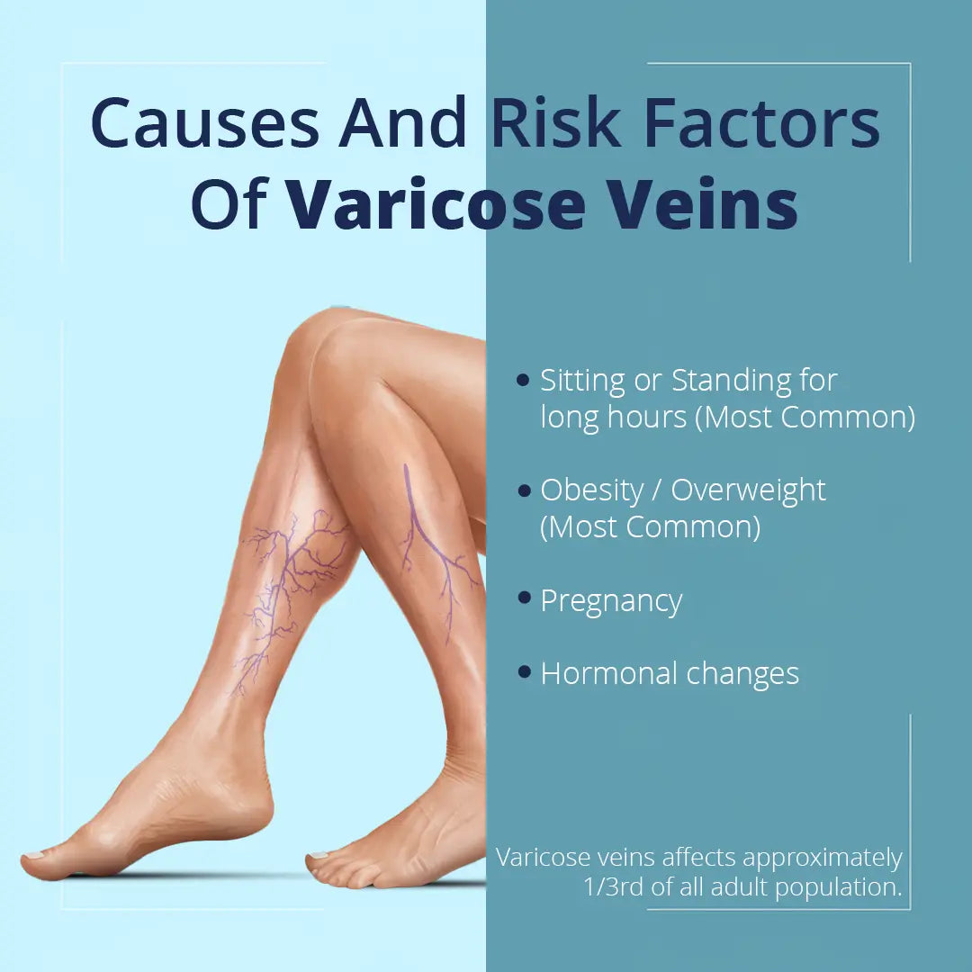 Illustration of varicose veins on legs with common causes like sitting, obesity, pregnancy, and hormonal changes